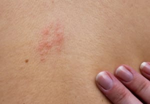 ¿Ronchas, irritación o herpes?: Cómo saberlo