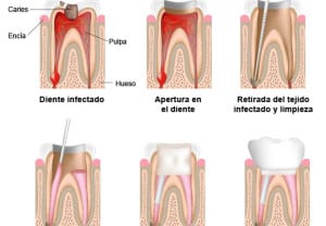 como-se-hace-endodoncia