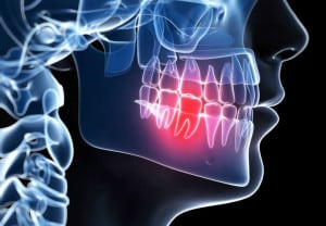 3d rendered illustration of a painful tooth