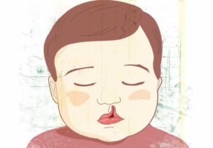 Como-corregir-el-labio-y-paladar-hendido