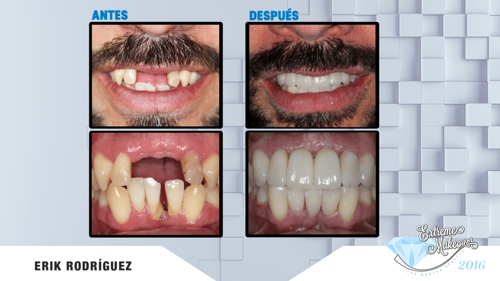dientes-el