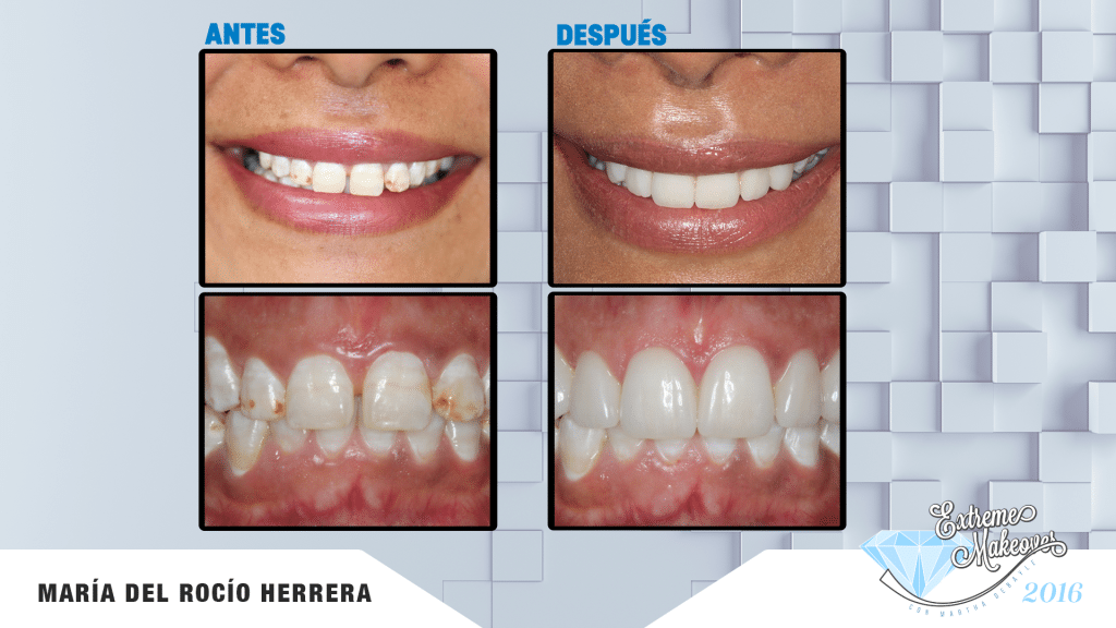 dientes-ella