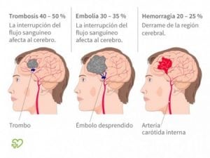 migraña