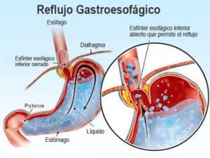reflu