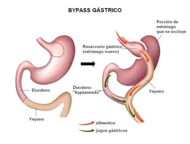 bypass