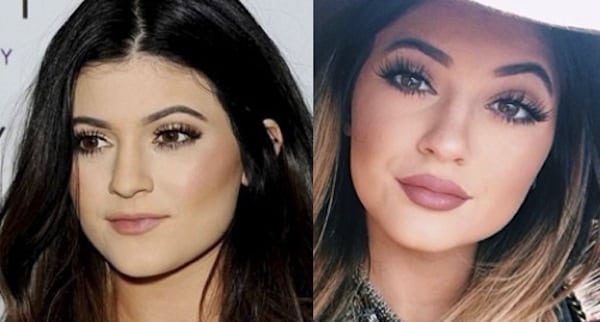 kylie-jenner-plastic-surgery-2