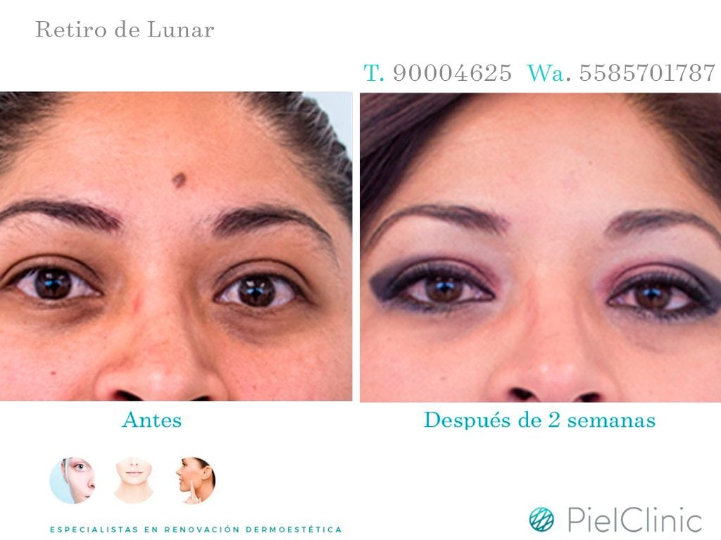 RETIRO DE LUNAR BEFORE AND AFTER