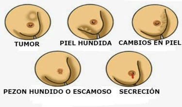 cancer10