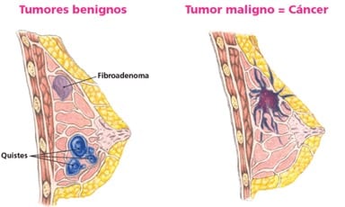 cancer3