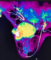 cancer8
