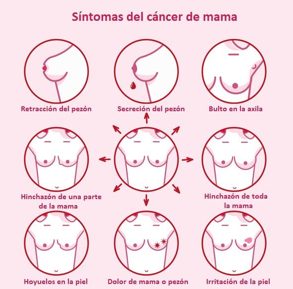 cáncer de mama
