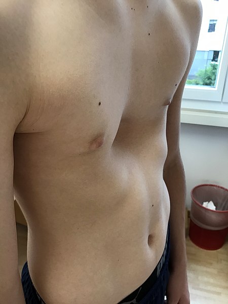 Pectus Excavatum