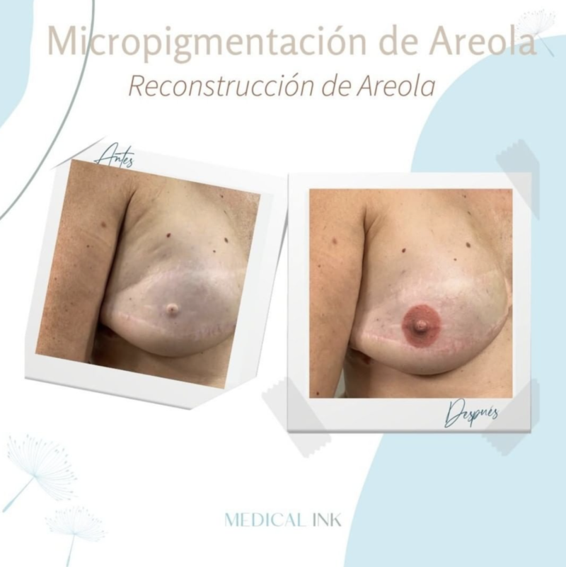 micropigmentación reconstructiva de mamas
