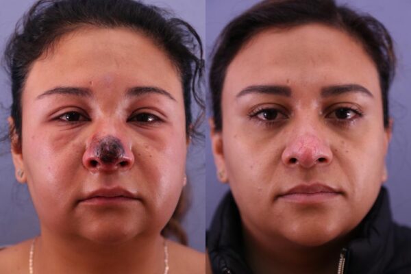 CIRUGÍAS QUE QUEDARON MAL ÁCIDO HIALURÓNICO
