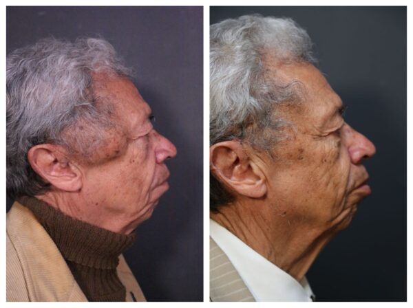 cómo se ve un lipoma en la cara pablo ofarril