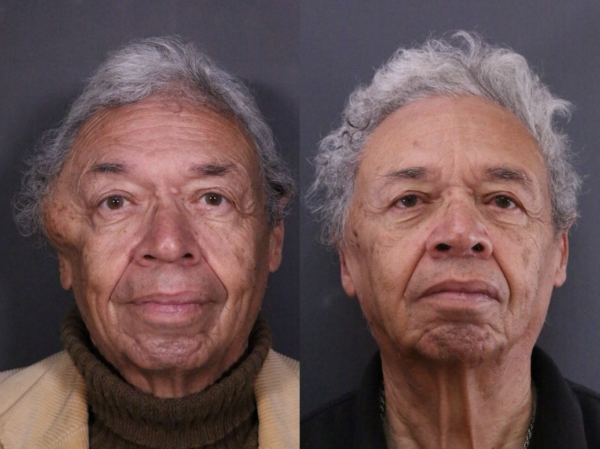 lipoma pablo ofarril martha debayle
